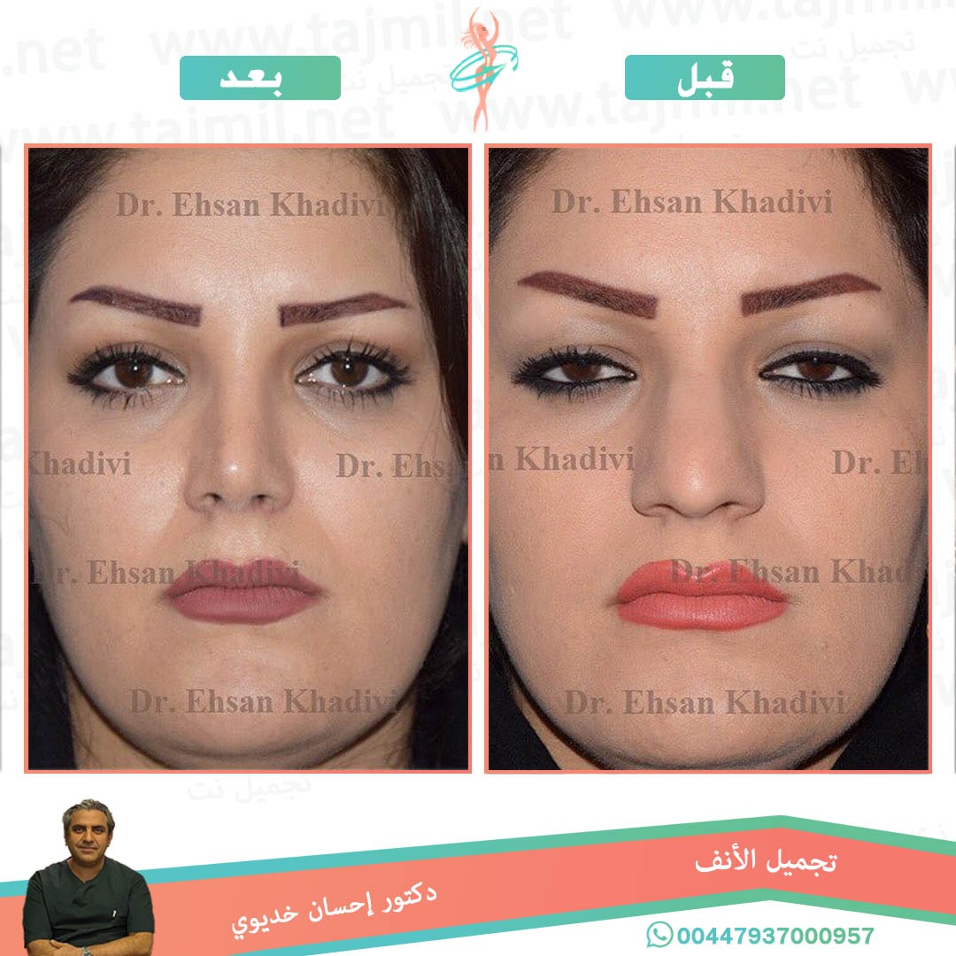  - دکتور إحسان خدیوي عملية تجميل الانف في ايران مع تجميل نت