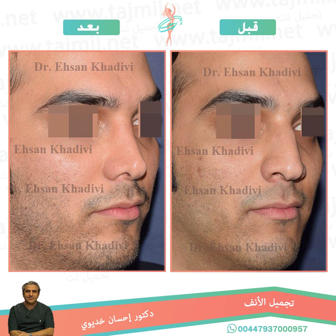  - دکتور إحسان خدیوي عملية تجميل الانف في ايران مع تجميل نت