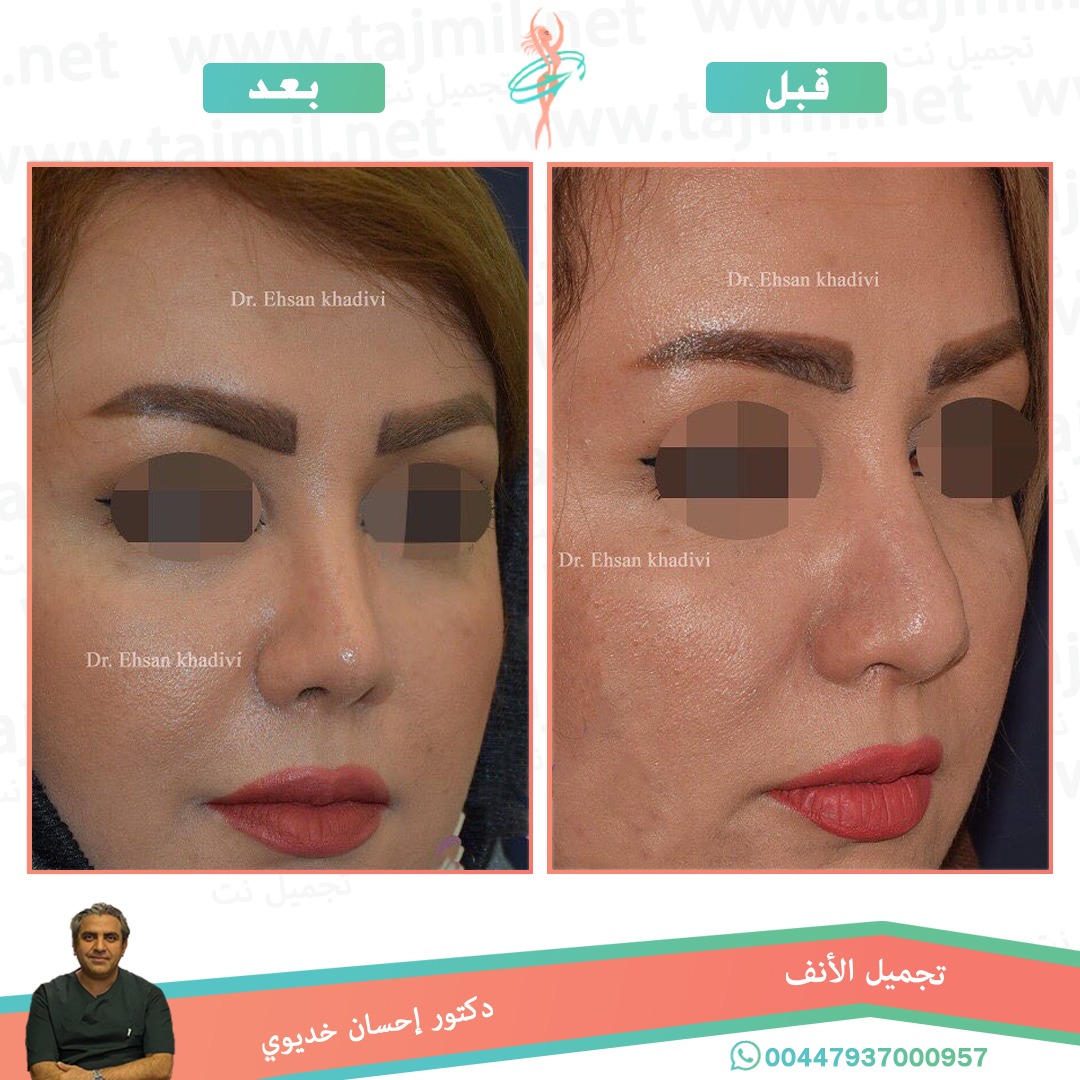  - دکتور إحسان خدیوي عملية تجميل الانف في ايران مع تجميل نت