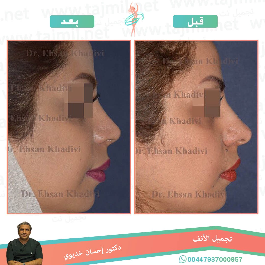  - دکتور إحسان خدیوي عملية تجميل الانف في ايران مع تجميل نت