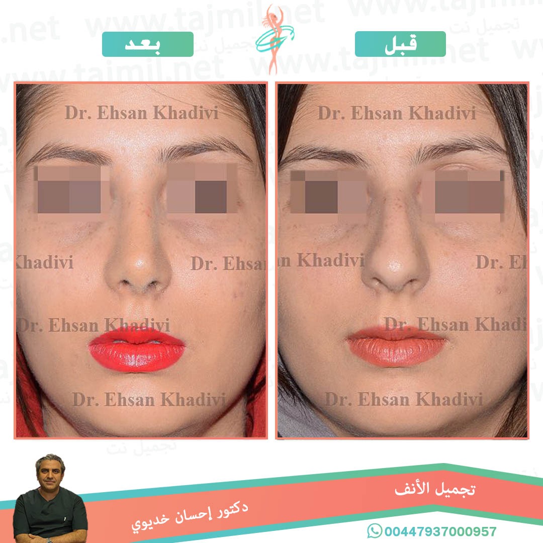  - دکتور إحسان خدیوي عملية تجميل الانف في ايران مع تجميل نت