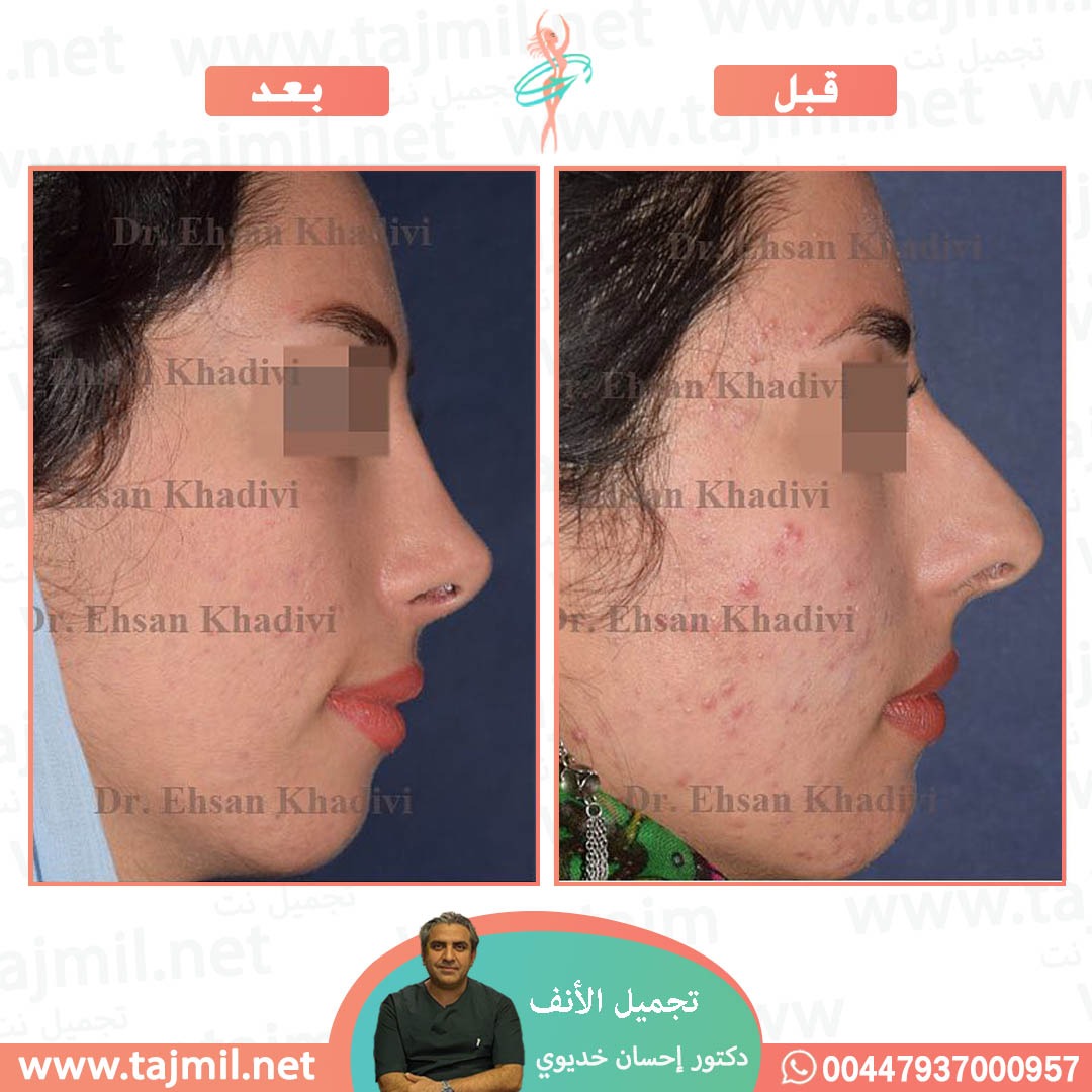  - دکتور إحسان خدیوي عملية تجميل الانف في ايران مع تجميل نت