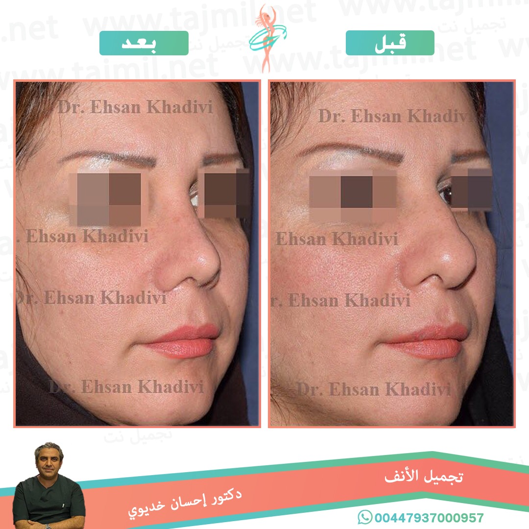  - دکتور إحسان خدیوي عملية تجميل الانف في ايران مع تجميل نت