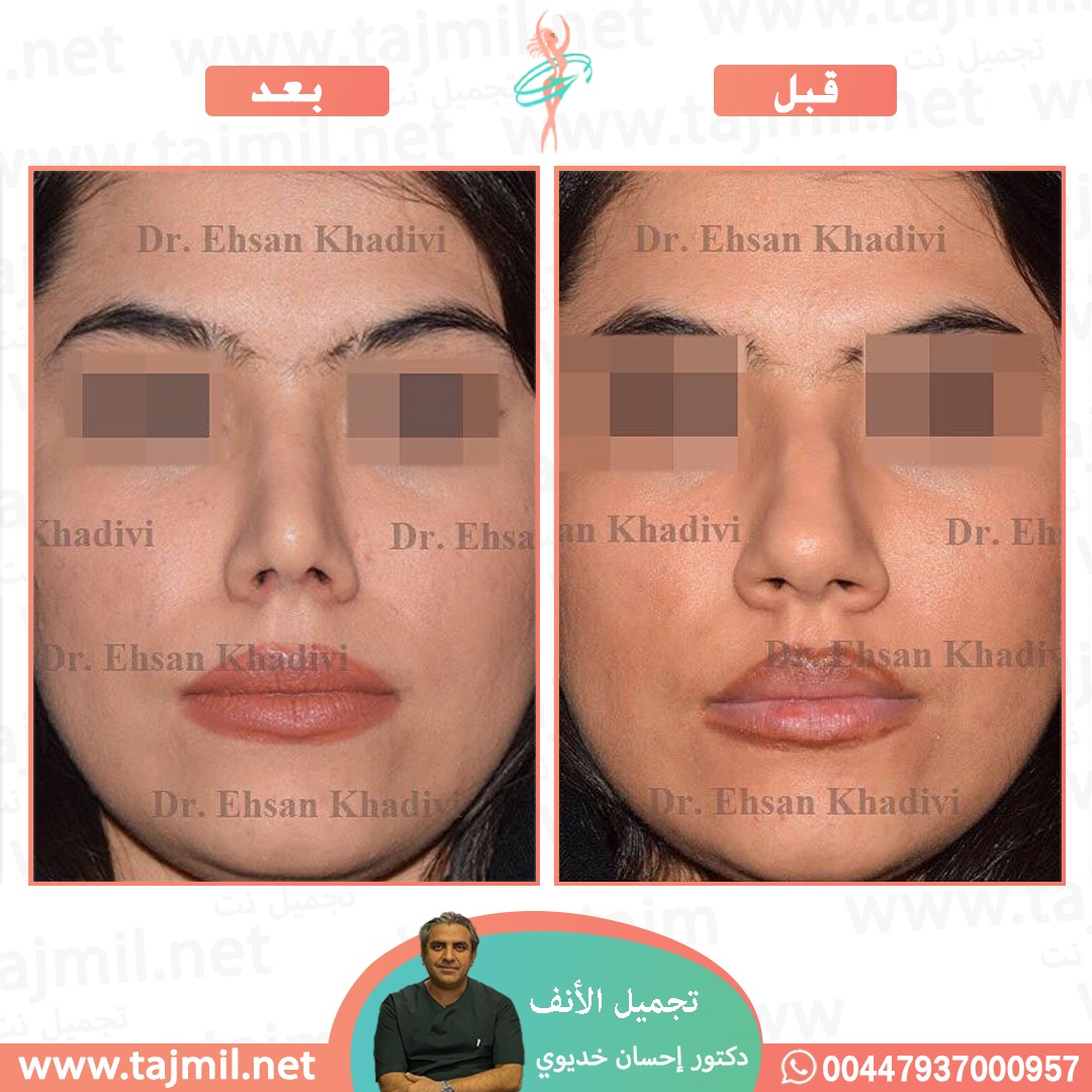  - دکتور إحسان خدیوي عملية تجميل الانف في ايران مع تجميل نت