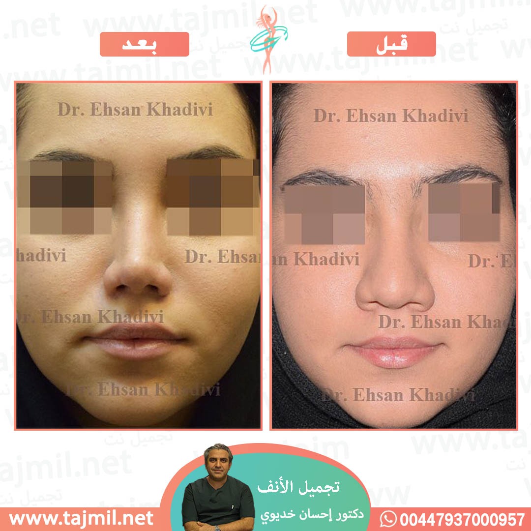  - دکتور إحسان خدیوي عملية تجميل الانف في ايران مع تجميل نت