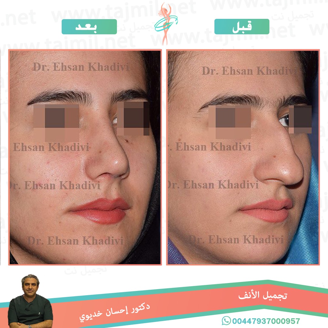  - دکتور إحسان خدیوي عملية تجميل الانف في ايران مع تجميل نت