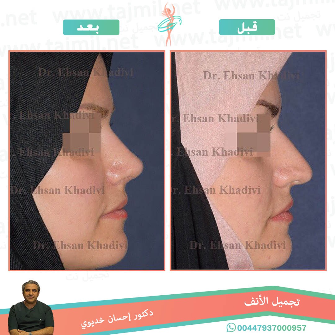  - دکتور إحسان خدیوي عملية تجميل الانف في ايران مع تجميل نت