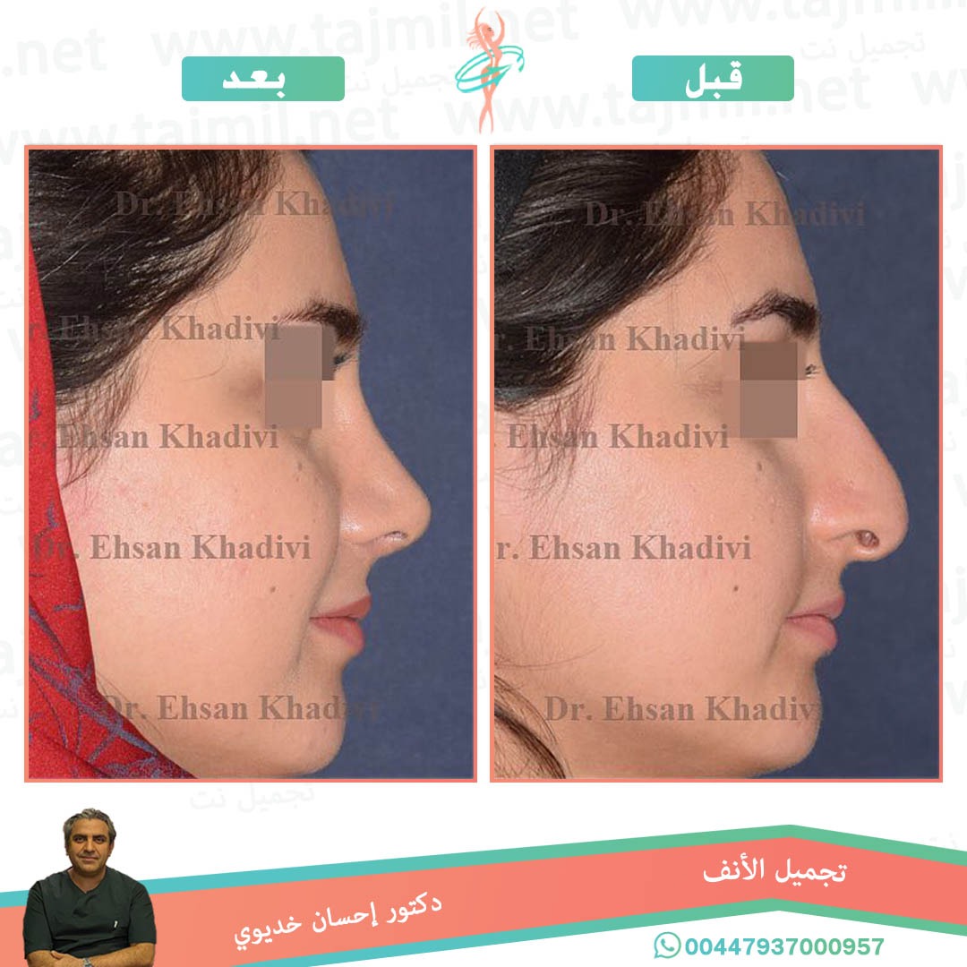  - دکتور إحسان خدیوي عملية تجميل الانف في ايران مع تجميل نت