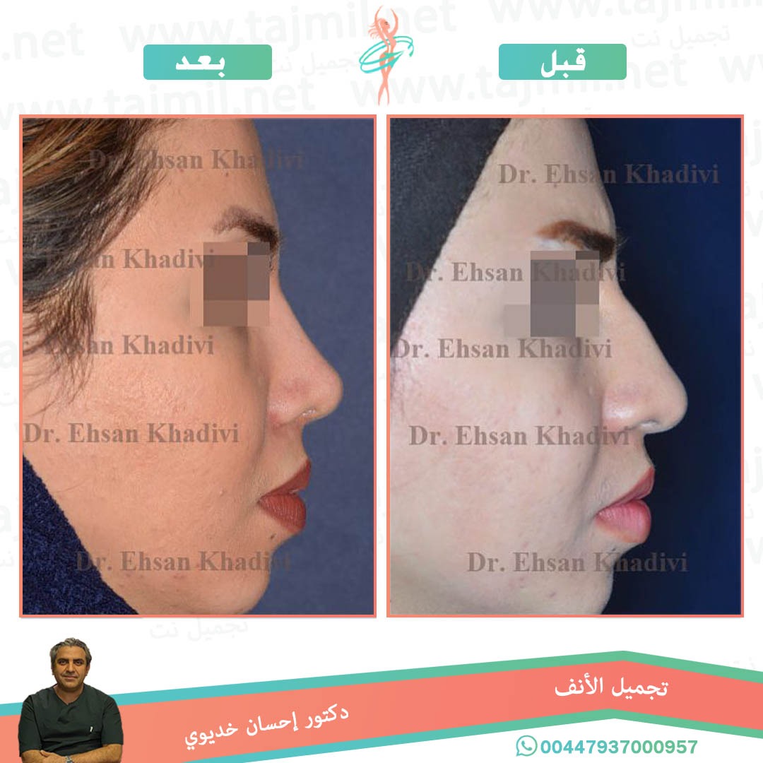  - دکتور إحسان خدیوي عملية تجميل الانف في ايران مع تجميل نت