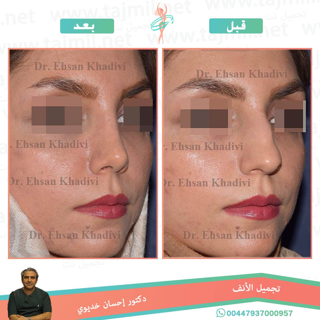  - دکتور إحسان خدیوي عملية تجميل الانف في ايران مع تجميل نت