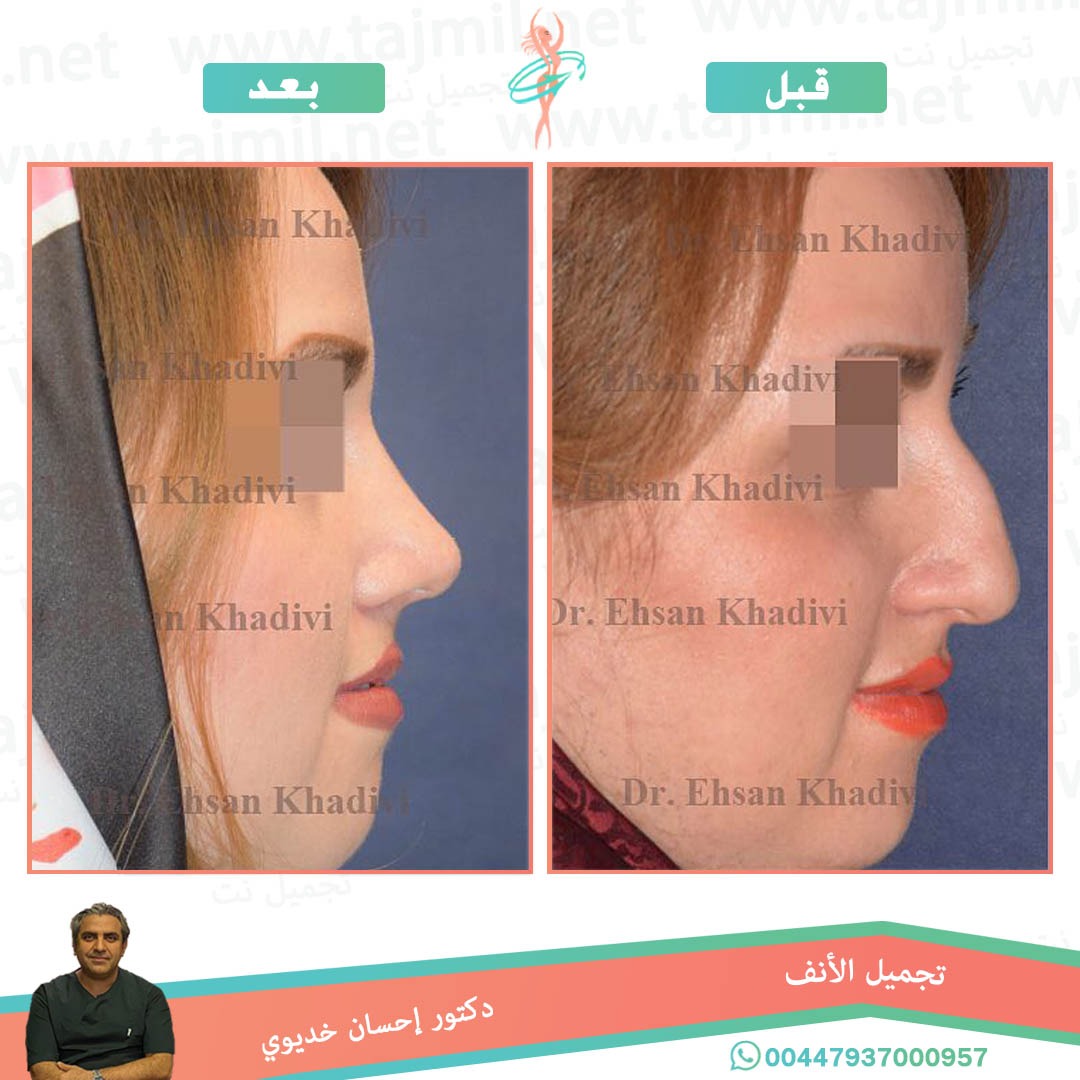  - دکتور إحسان خدیوي عملية تجميل الانف في ايران مع تجميل نت