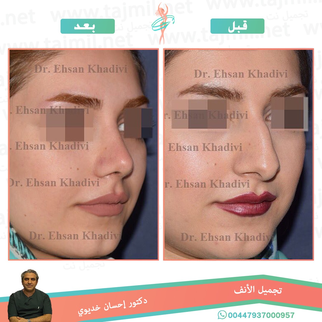  - دکتور إحسان خدیوي عملية تجميل الانف في ايران مع تجميل نت