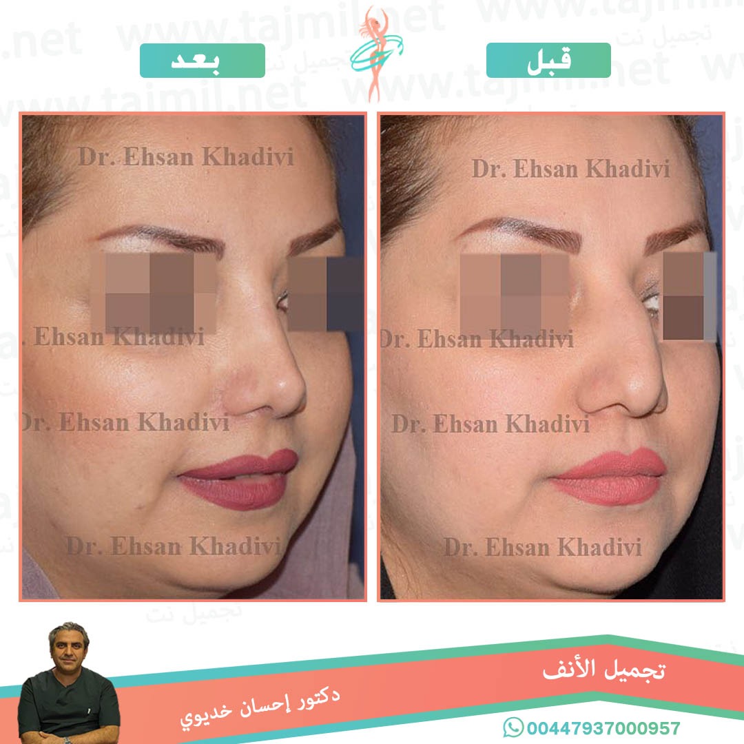  - دکتور إحسان خدیوي عملية تجميل الانف في ايران مع تجميل نت