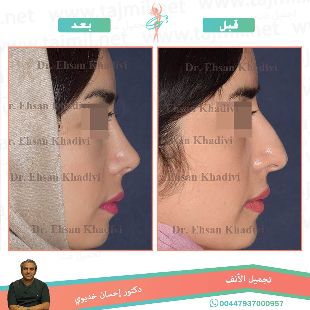  - دکتور إحسان خدیوي عملية تجميل الانف في ايران مع تجميل نت