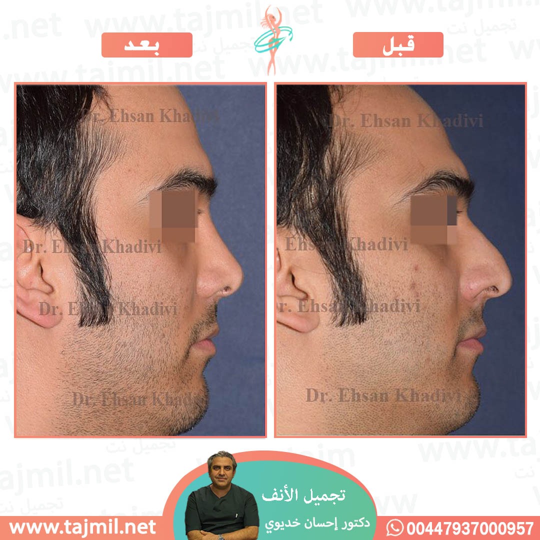  - دکتور إحسان خدیوي عملية تجميل الانف في ايران مع تجميل نت