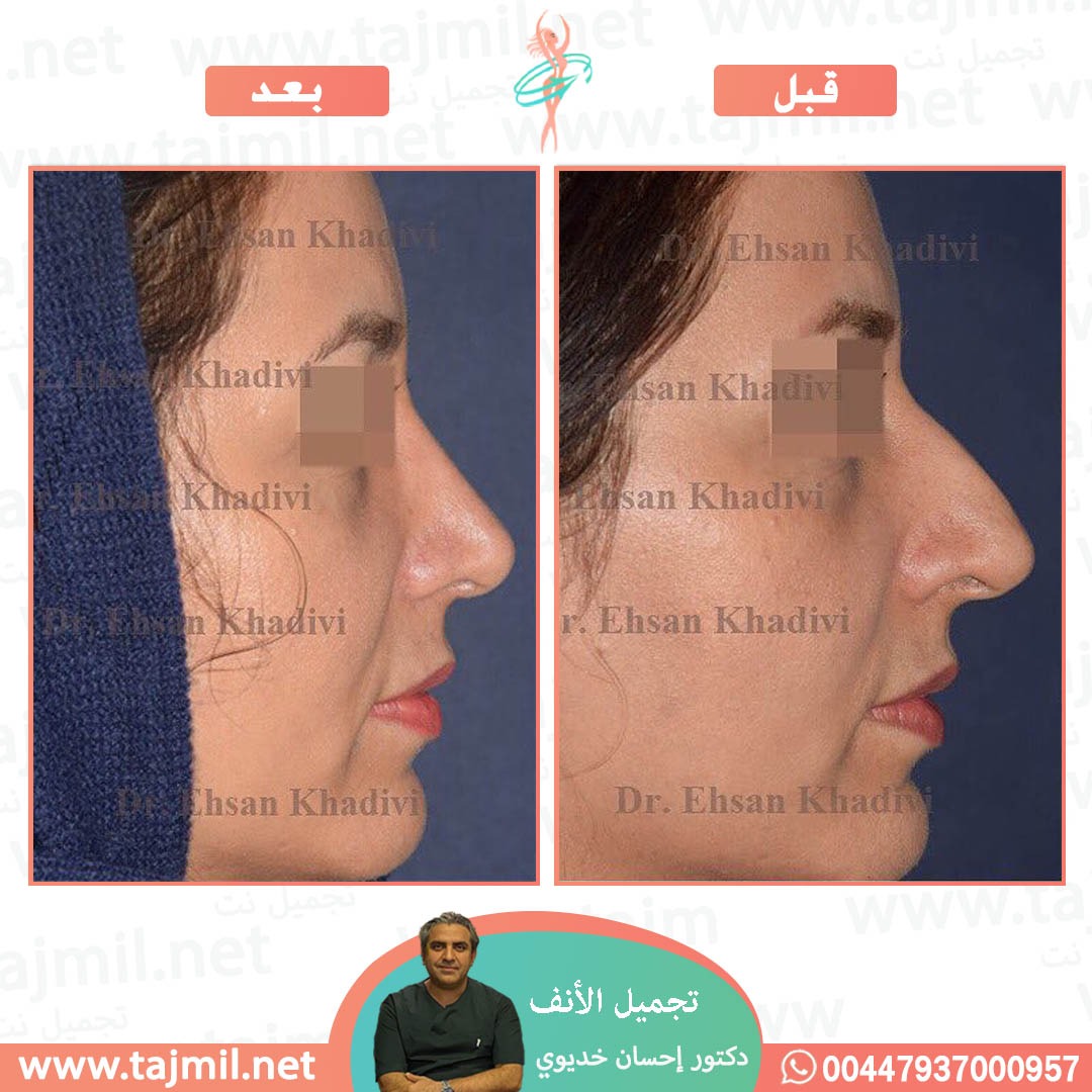  - دکتور إحسان خدیوي عملية تجميل الانف في ايران مع تجميل نت