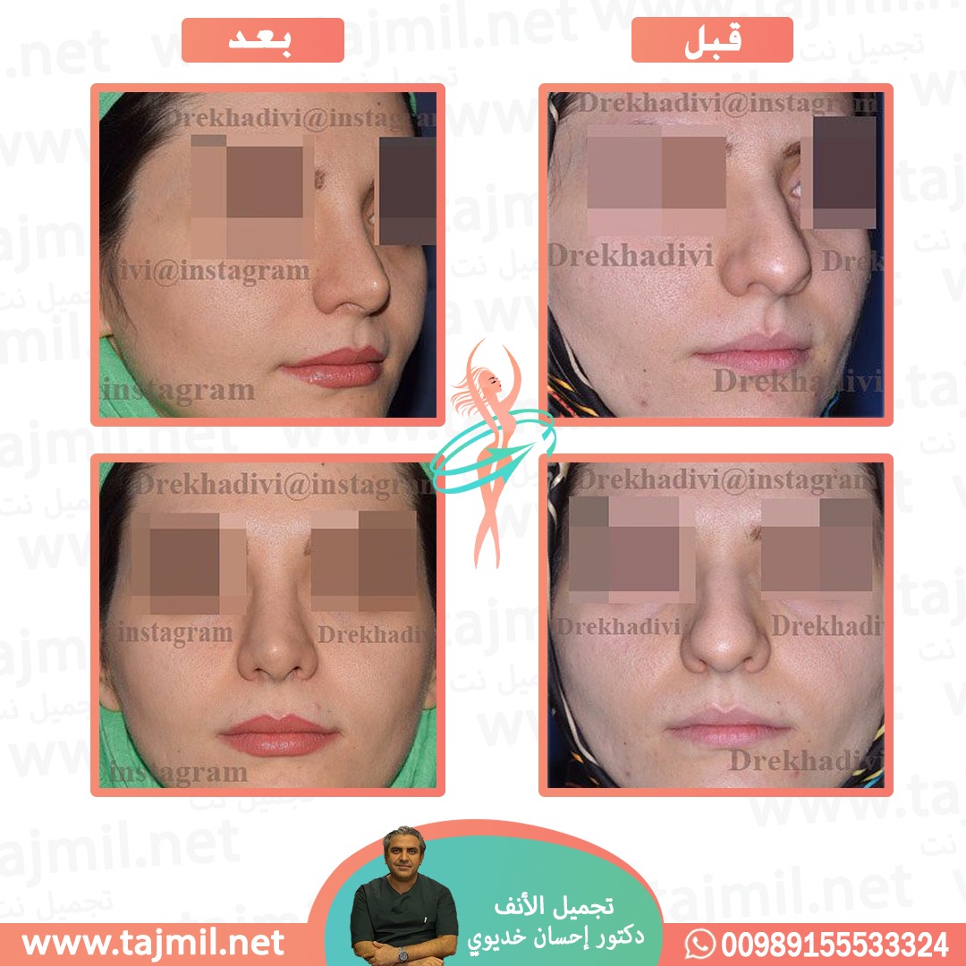  - دکتور إحسان خدیوي عملية تجميل الانف في ايران مع تجميل نت