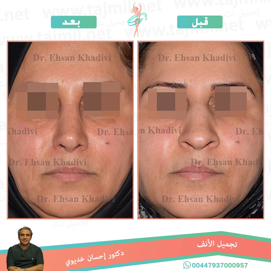  - دکتور إحسان خدیوي عملية تجميل الانف في ايران مع تجميل نت