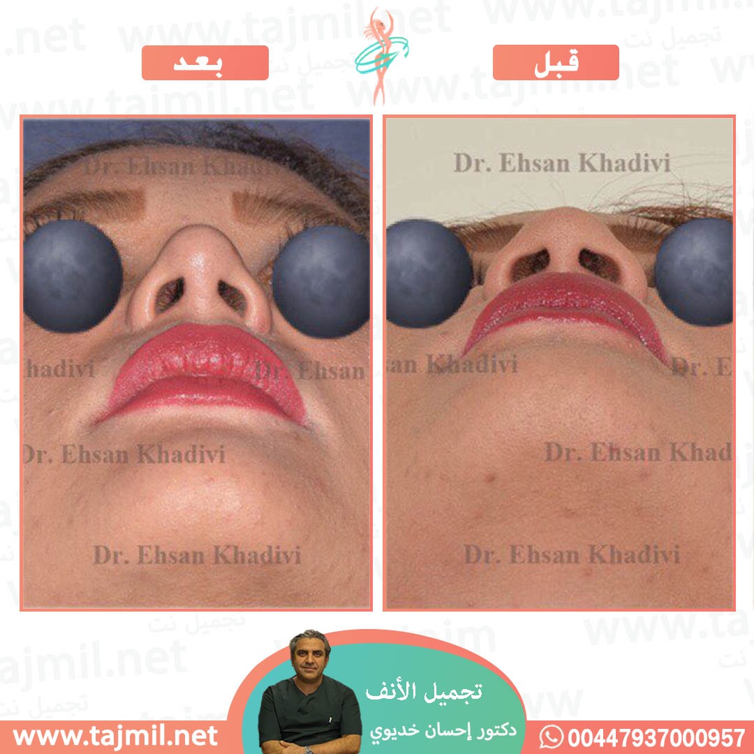  - دکتور إحسان خدیوي عملية تجميل الانف في ايران مع تجميل نت