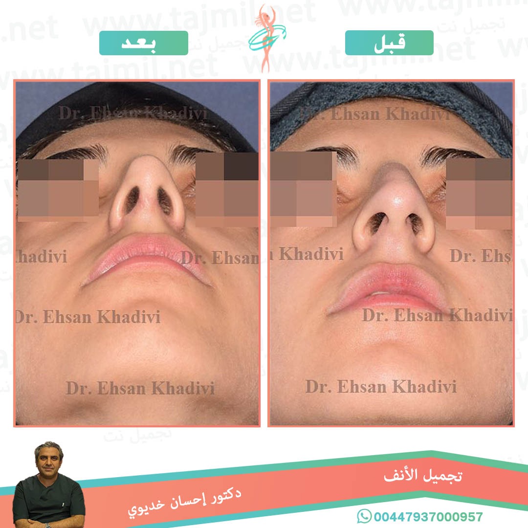  - دکتور إحسان خدیوي عملية تجميل الانف في ايران مع تجميل نت