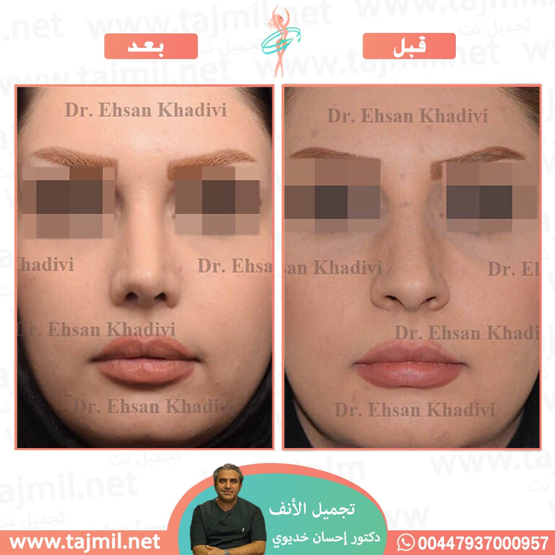  - دکتور إحسان خدیوي عملية تجميل الانف في ايران مع تجميل نت