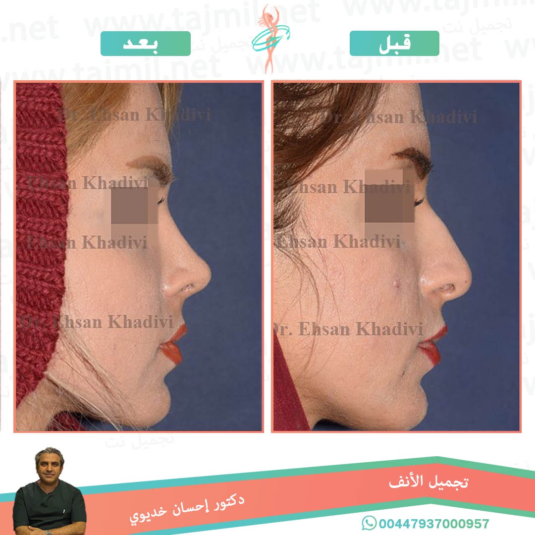  - دکتور إحسان خدیوي عملية تجميل الانف في ايران مع تجميل نت