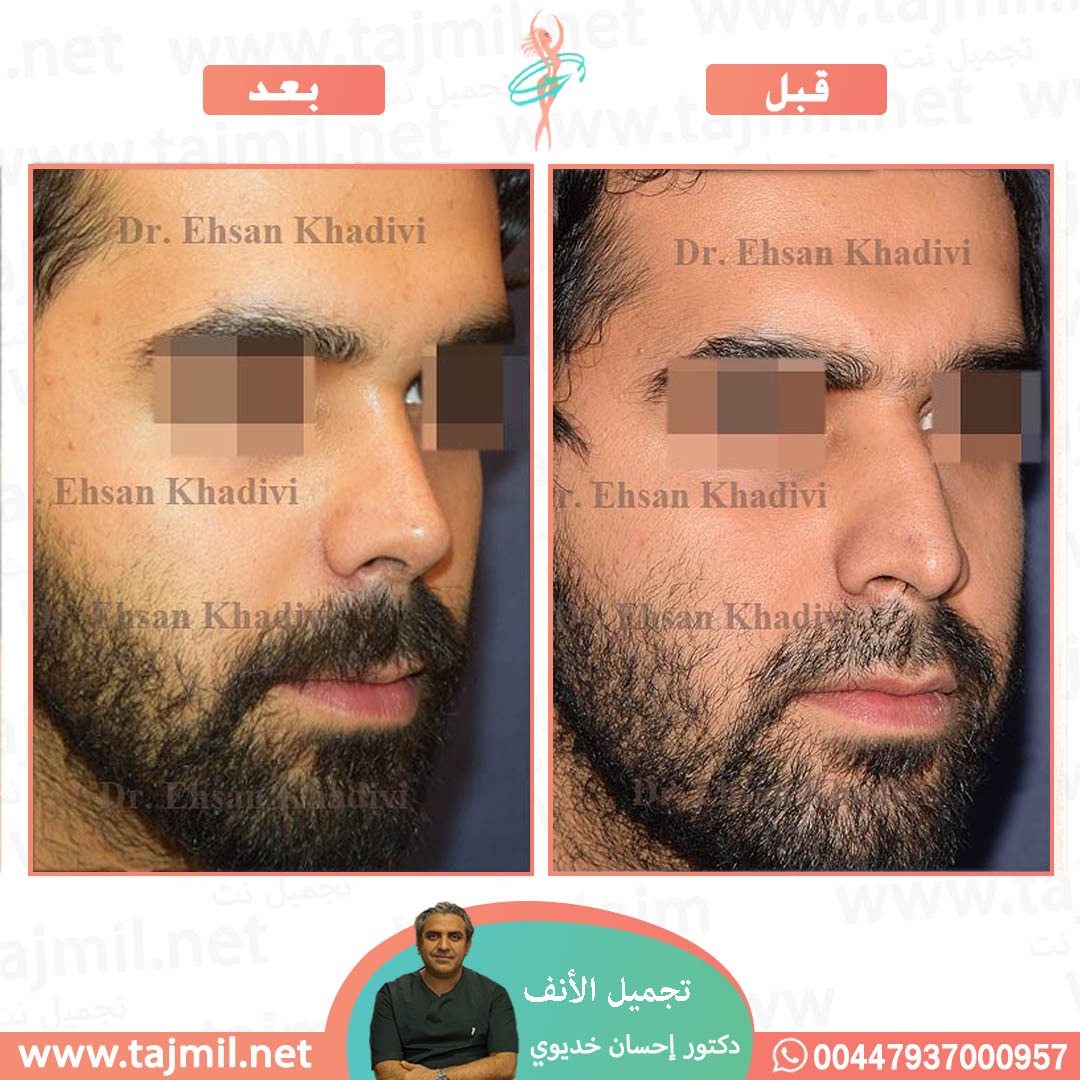  - دکتور إحسان خدیوي عملية تجميل الانف في ايران مع تجميل نت