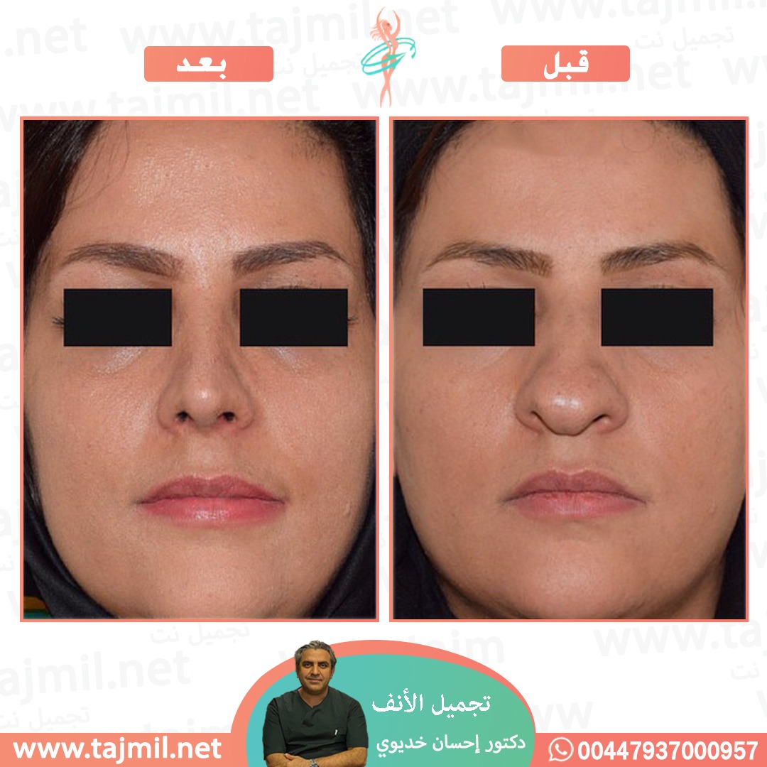  - دکتور إحسان خدیوي عملية تجميل الانف في ايران مع تجميل نت