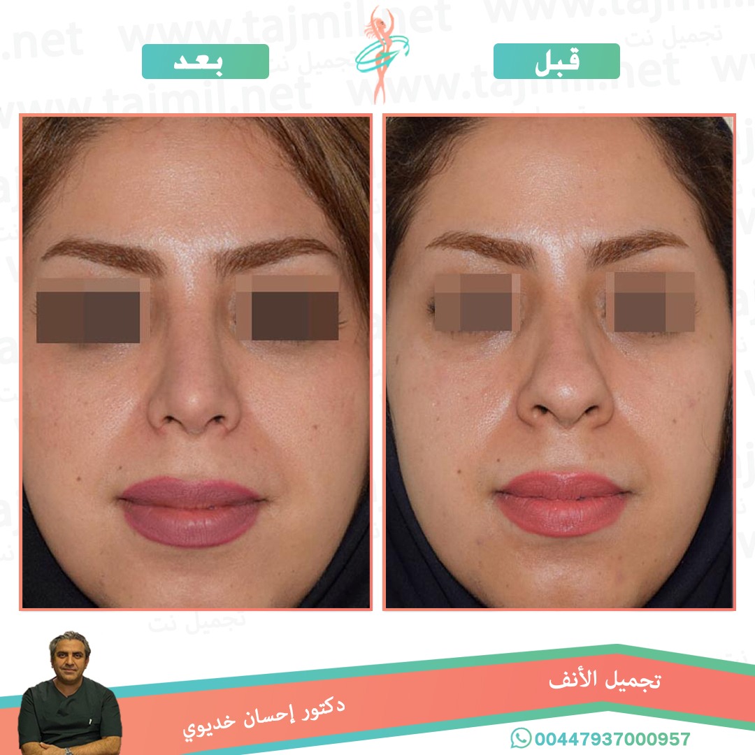  - دکتور إحسان خدیوي عملية تجميل الانف في ايران مع تجميل نت