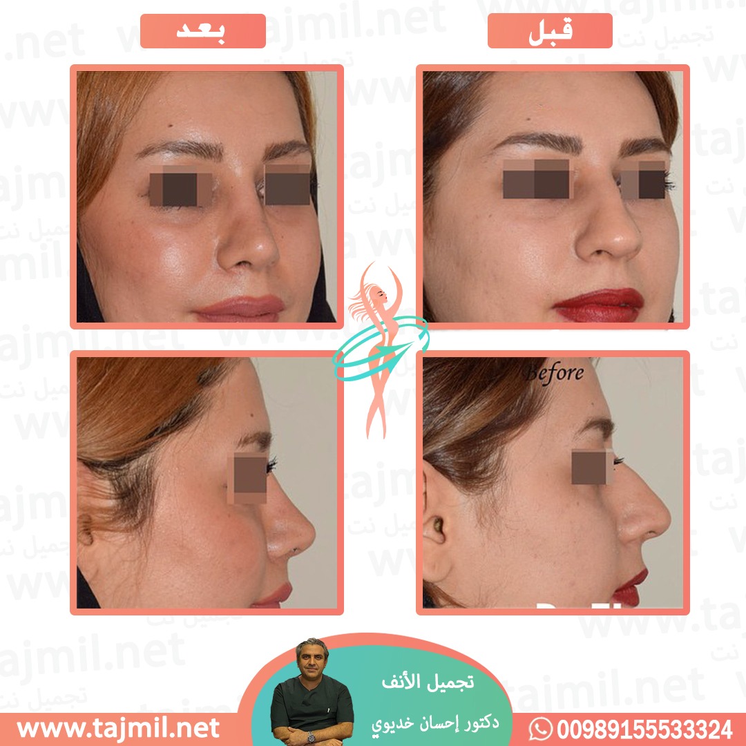  - دکتور إحسان خدیوي عملية تجميل الانف في ايران مع تجميل نت