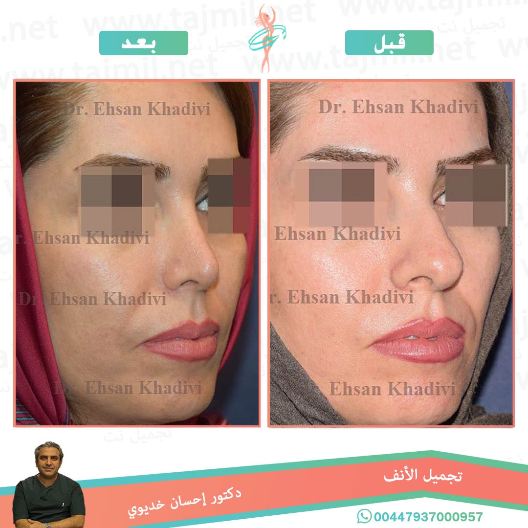  - دکتور إحسان خدیوي عملية تجميل الانف في ايران مع تجميل نت