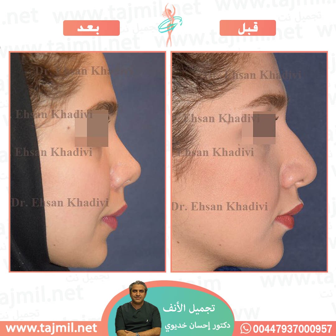  - دکتور إحسان خدیوي عملية تجميل الانف في ايران مع تجميل نت