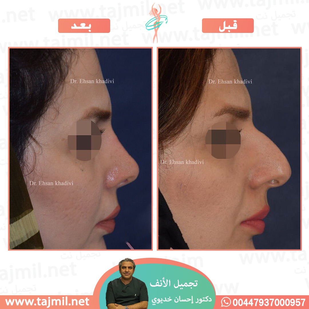  - دکتور إحسان خدیوي عملية تجميل الانف في ايران مع تجميل نت