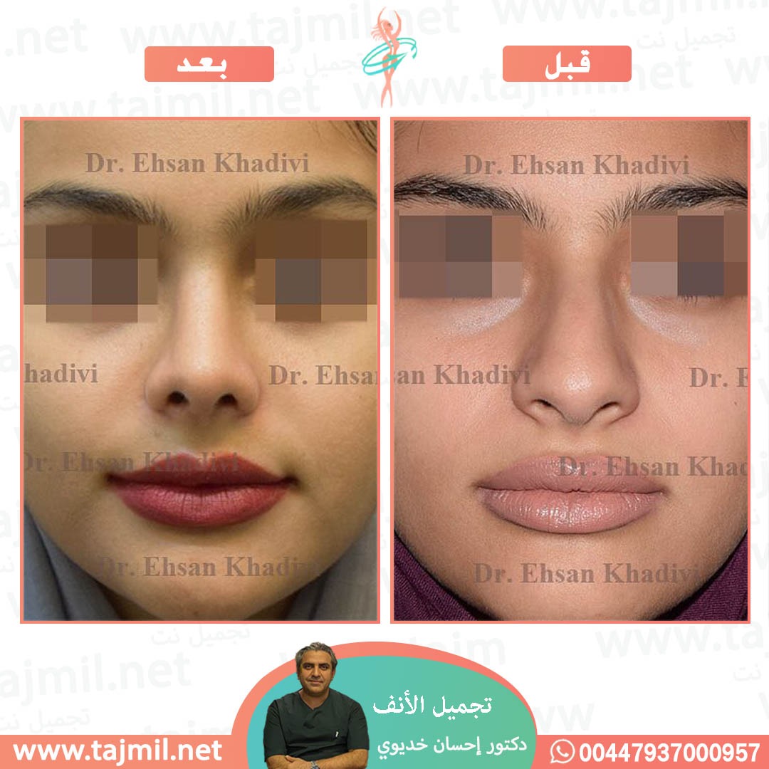  - دکتور إحسان خدیوي عملية تجميل الانف في ايران مع تجميل نت