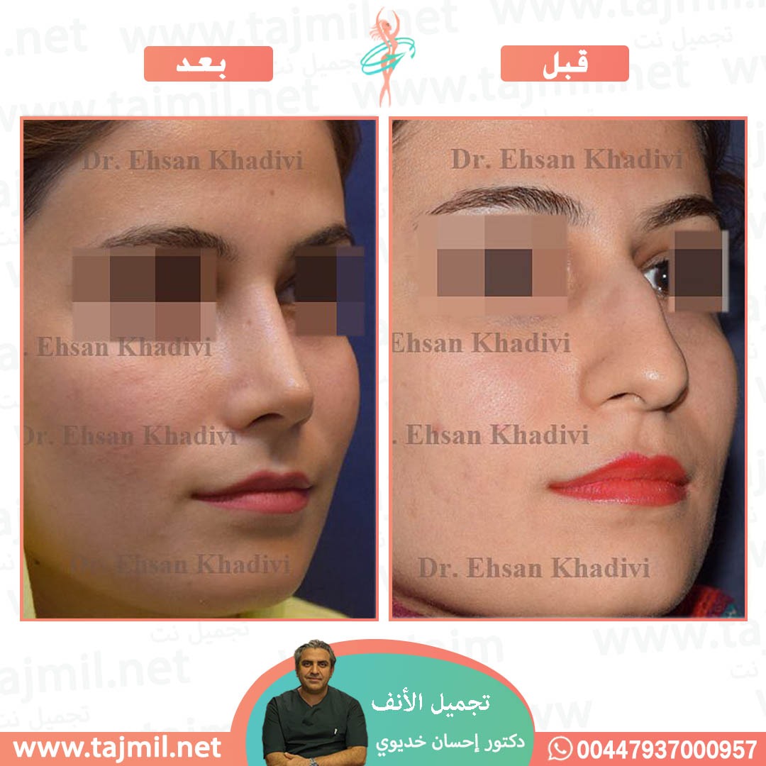  - دکتور إحسان خدیوي عملية تجميل الانف في ايران مع تجميل نت