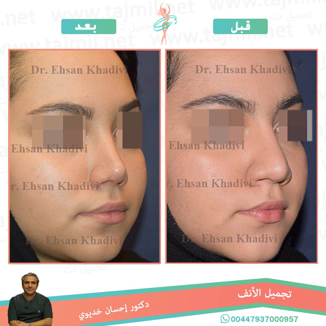  - دکتور إحسان خدیوي عملية تجميل الانف في ايران مع تجميل نت