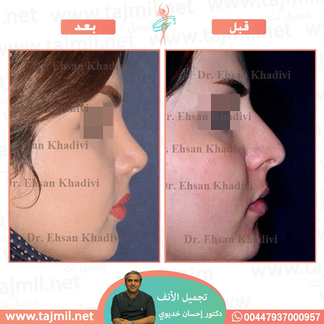  - دکتور إحسان خدیوي عملية تجميل الانف في ايران مع تجميل نت