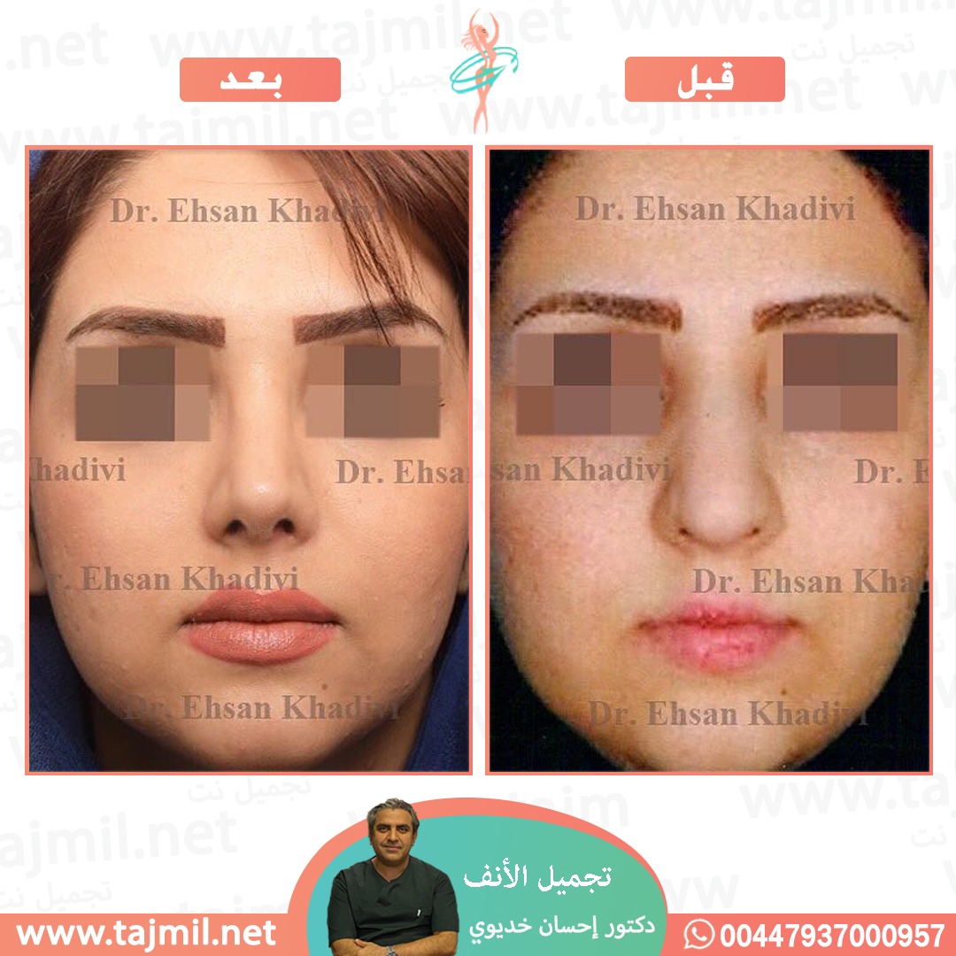  - دکتور إحسان خدیوي عملية تجميل الانف في ايران مع تجميل نت