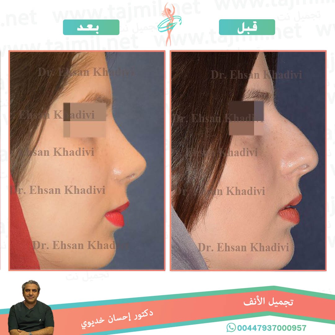  - دکتور إحسان خدیوي عملية تجميل الانف في ايران مع تجميل نت