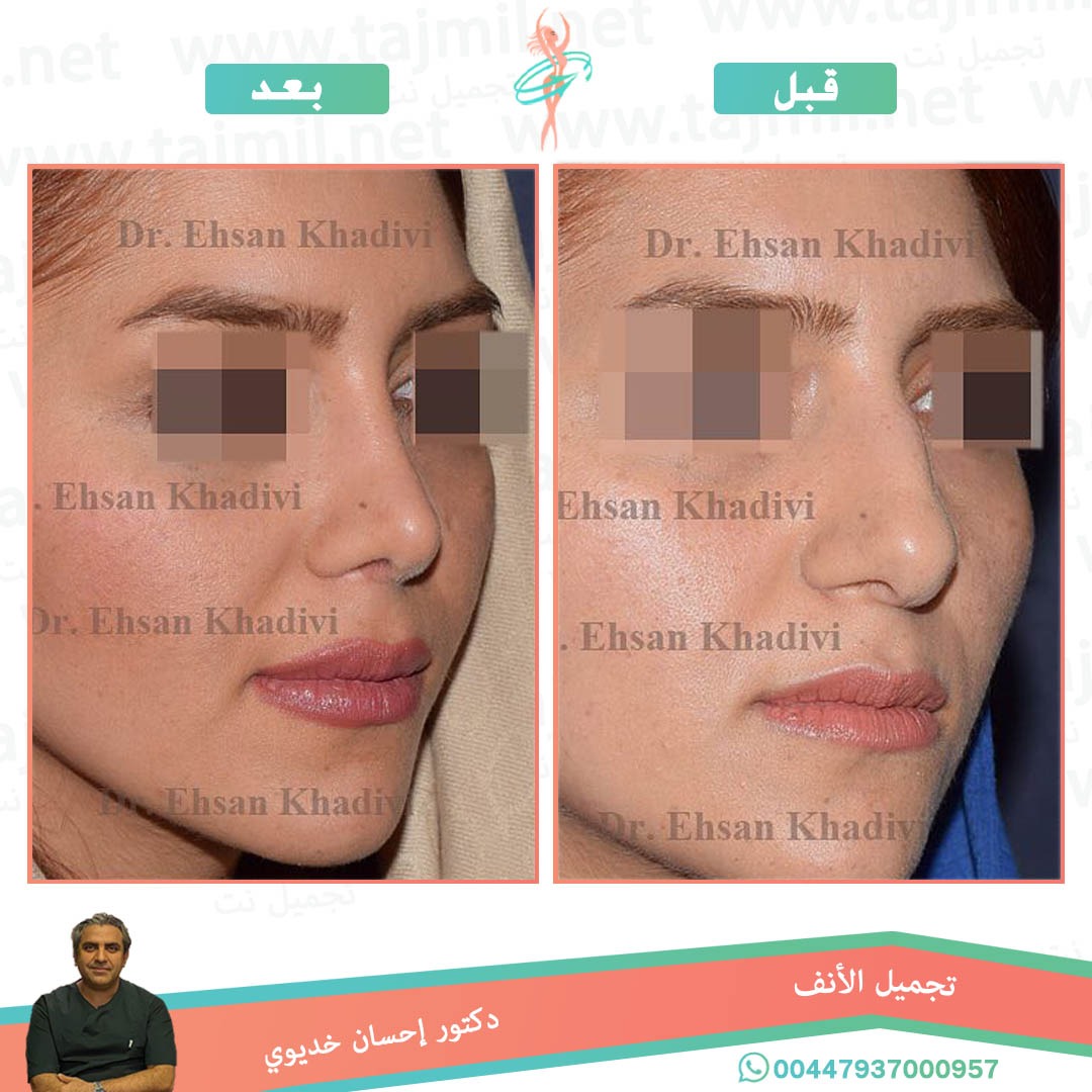  - دکتور إحسان خدیوي عملية تجميل الانف في ايران مع تجميل نت