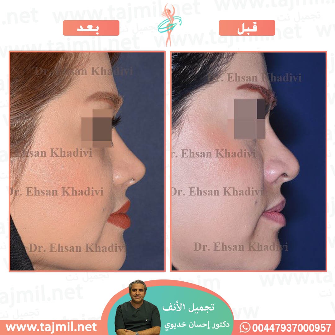  - دکتور إحسان خدیوي عملية تجميل الانف في ايران مع تجميل نت