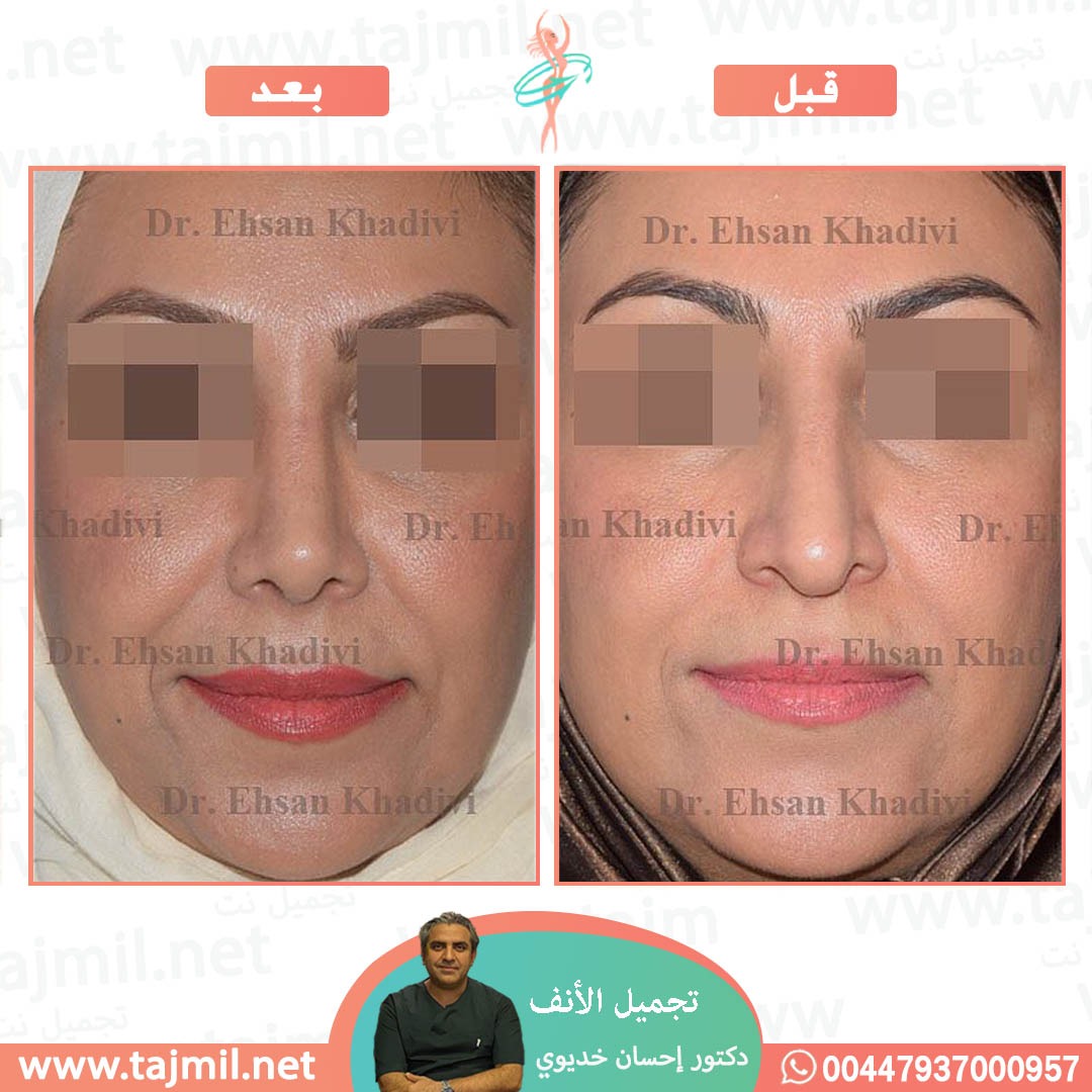  - دکتور إحسان خدیوي عملية تجميل الانف في ايران مع تجميل نت