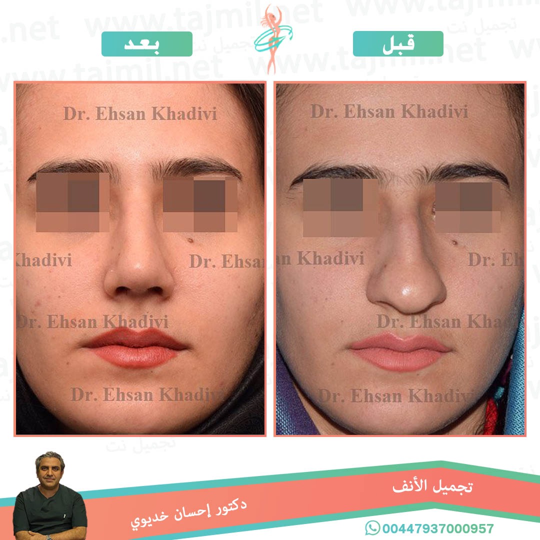  - دکتور إحسان خدیوي عملية تجميل الانف في ايران مع تجميل نت