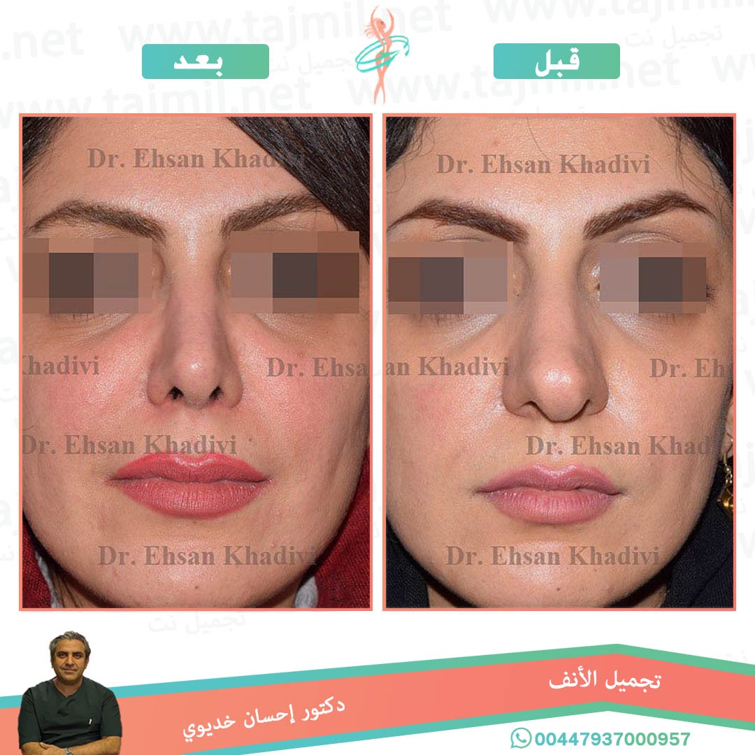  - دکتور إحسان خدیوي عملية تجميل الانف في ايران مع تجميل نت