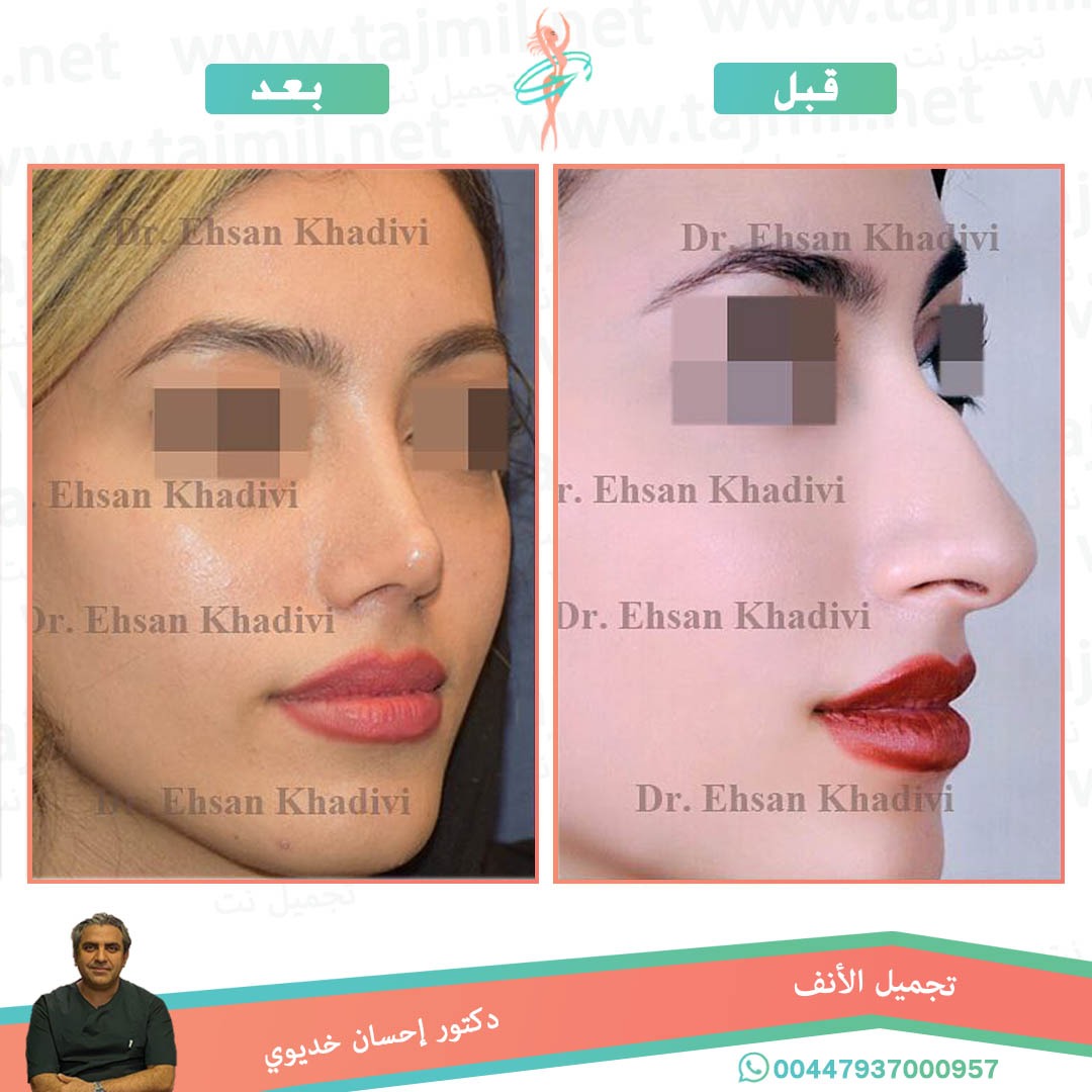  - دکتور إحسان خدیوي عملية تجميل الانف في ايران مع تجميل نت