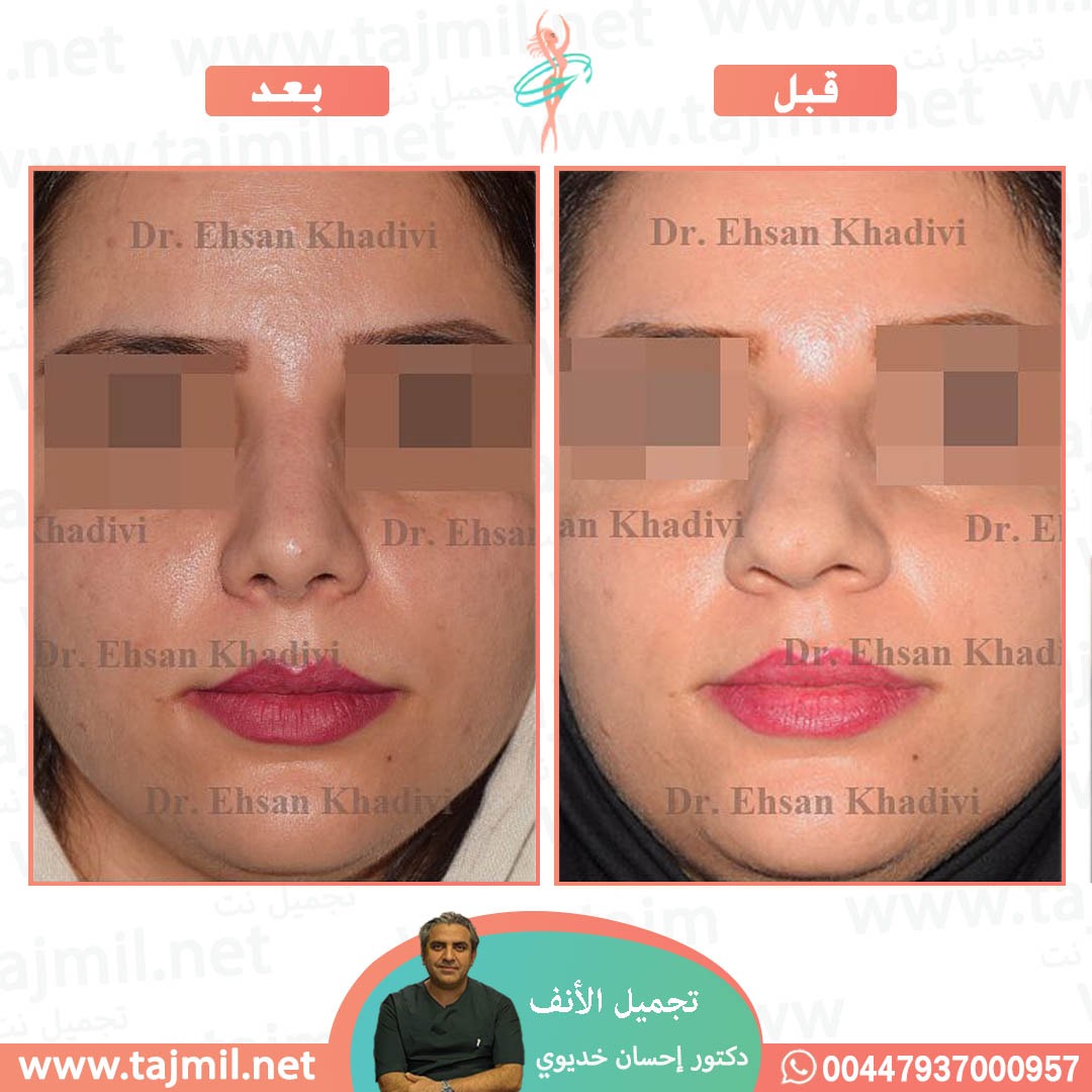  - دکتور إحسان خدیوي عملية تجميل الانف في ايران مع تجميل نت