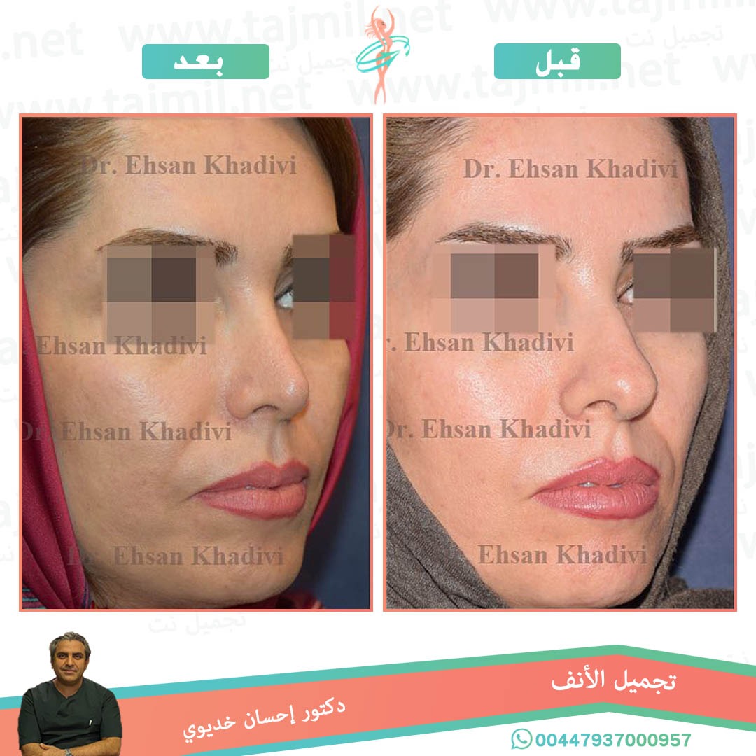  - دکتور إحسان خدیوي عملية تجميل الانف في ايران مع تجميل نت