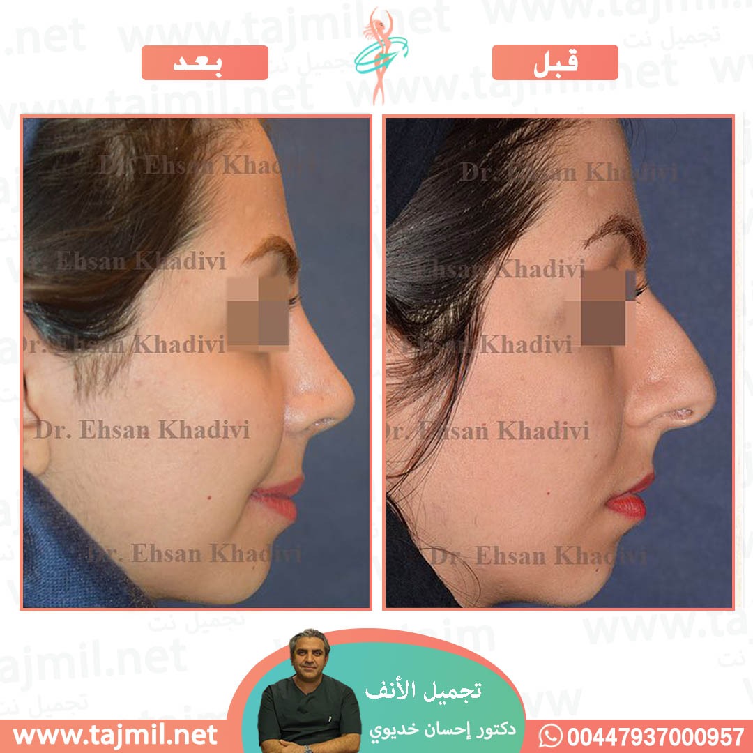  - دکتور إحسان خدیوي عملية تجميل الانف في ايران مع تجميل نت