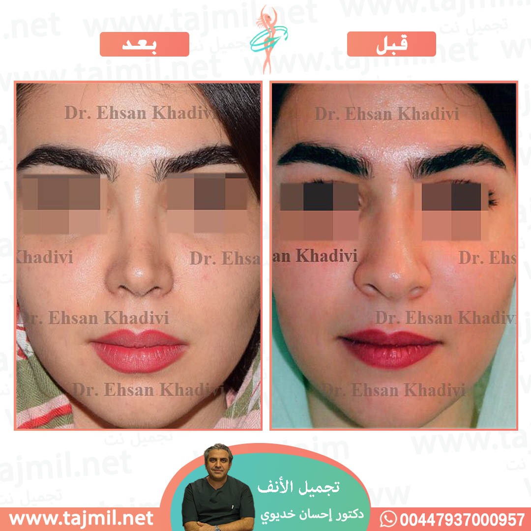  - دکتور إحسان خدیوي عملية تجميل الانف في ايران مع تجميل نت