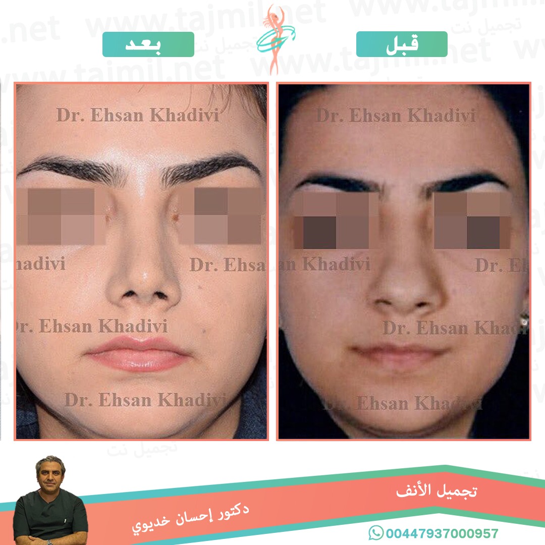  - دکتور إحسان خدیوي عملية تجميل الانف في ايران مع تجميل نت